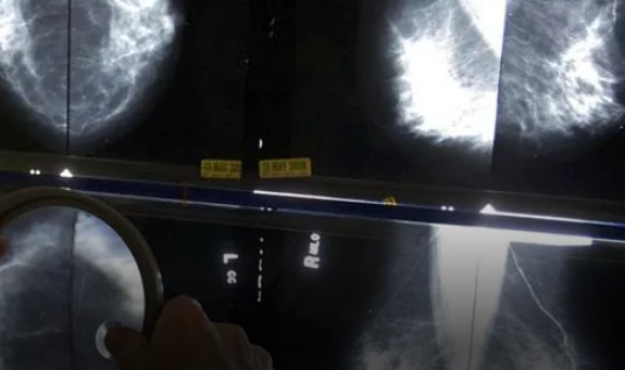 The Age For Breast Cancer Screening Will Be Reduced From 50 To 40
