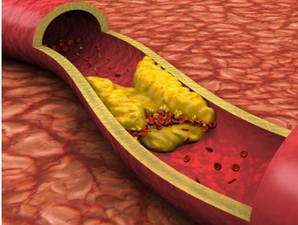 How Can The Cholesterol Level In The Body Be Reduced?